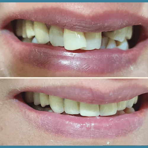 Digital dental setup